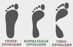 Виды пронации