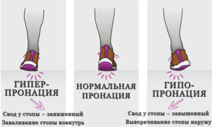 Виды пронации и их отличия