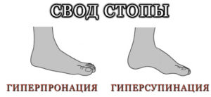 Виды пронации и их отличия